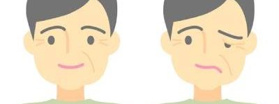 Paralisis-facial (1)