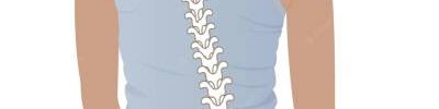 escoliosis