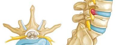 hernia-discal